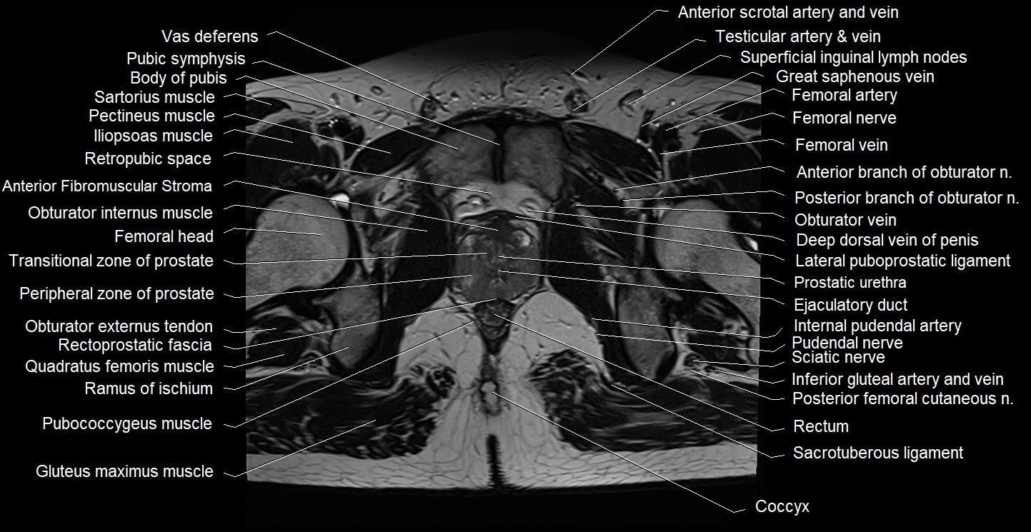 Male pelvis axial cross sectional anatomy image 34.webp